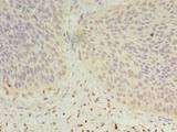 DHRS12 Antibody - Immunohistochemistry of paraffin-embedded human cervical cancer using antibody at dilution of 1:100.