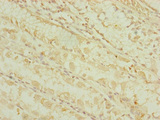 DHTKD1 Antibody - Immunohistochemistry of paraffin-embedded human gastric cancer at dilution of 1:100