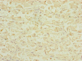 DHTKD1 Antibody - Immunohistochemistry of paraffin-embedded human gastric cancer at dilution of 1:100