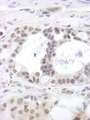 DHX15 Antibody - Detection of Human DHX15 by Immunohistochemistry. Sample: FFPE section of human ovarian tumor. Antibody: Affinity purified rabbit anti-DHX15 used at a dilution of 1:250.
