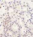 DHX38 Antibody - Detection of Human DHX38 by Immunohistochemistry. Sample: FFPE section of human breast carcinoma. Antibody: Affinity purified rabbit anti-DHX38 used at a dilution of 1:200 (1 ug/ml). Detection: DAB.