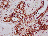 DHX38 Antibody - Immunohistochemistry Dilution at 1:400 and staining in paraffin-embedded human breast cancer performed on a Leica BondTM system. After dewaxing and hydration, antigen retrieval was mediated by high pressure in a citrate buffer (pH 6.0). Section was blocked with 10% normal Goat serum 30min at RT. Then primary antibody (1% BSA) was incubated at 4°C overnight. The primary is detected by a biotinylated Secondary antibody and visualized using an HRP conjugated SP system.