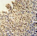 DIS3L Antibody - DI3L1 Antibody immunohistochemistry of formalin-fixed and paraffin-embedded human cervix carcinoma followed by peroxidase-conjugated secondary antibody and DAB staining.