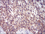 DIS3L2 Antibody - IHC of paraffin-embedded bladder cancer tissues using DIS3L2 mouse monoclonal antibody with DAB staining.