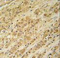 DKC1 / Dyskerin Antibody - DKC1 Antibody immunohistochemistry of formalin-fixed and paraffin-embedded human prostate carcinoma followed by peroxidase-conjugated secondary antibody and DAB staining.