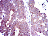 DLL4 Antibody - IHC of paraffin-embedded rectum cancer tissues using DLL4 mouse monoclonal antibody with DAB staining.