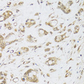 DMAP1 Antibody - Immunohistochemistry of paraffin-embedded human gastric cancer tissue.