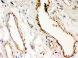 DMD / Dystrophin Antibody - Dystrophin antibody IHC-paraffin: Human Lung Cancer Tissue.