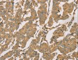DMRTA3 / DMRT3 Antibody - Immunohistochemistry of paraffin-embedded Human breast cancer using DMRT3 Polyclonal Antibody at dilution of 1:50.