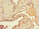 DNAH1 Antibody - Immunohistochemistry of paraffin-embedded human prostate cancer at dilution of 1:100