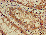 DNAJC4 Antibody - Immunohistochemistry image of paraffin-embedded human colon cancer at a dilution of 1:100