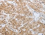 DNAJC7 Antibody - Immunohistochemistry of paraffin-embedded Human lung cancer using DNAJC7 Polyclonal Antibody at dilution of 1:25.