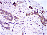 DNAL4 / Dynein Light Chain 4 Antibody - IHC of paraffin-embedded esophageal cancer tissues using DNAL4 mouse monoclonal antibody with DAB staining.