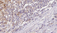 DNER / BET Antibody - 1:100 staining human liver carcinoma tissues by IHC-P. The sample was formaldehyde fixed and a heat mediated antigen retrieval step in citrate buffer was performed. The sample was then blocked and incubated with the antibody for 1.5 hours at 22°C. An HRP conjugated goat anti-rabbit antibody was used as the secondary.