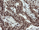 DNM1L / DRP1 Antibody - IHC of paraffin-embedded Adenocarcinoma of Human ovary tissue using anti-DNM1L mouse monoclonal antibody.