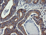 DNM1L / DRP1 Antibody - IHC of paraffin-embedded Carcinoma of Human pancreas tissue using anti-DNM1L mouse monoclonal antibody.