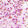 DNMT3B Antibody - Immunohistochemical analysis of DNMT3B staining in human breast cancer formalin fixed paraffin embedded tissue section. The section was pre-treated using heat mediated antigen retrieval with sodium citrate buffer (pH 6.0). The section was then incubated with the antibody at room temperature and detected using an HRP conjugated compact polymer system. DAB was used as the chromogen. The section was then counterstained with hematoxylin and mounted with DPX.