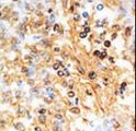 DOK1 Antibody - Formalin-fixed and paraffin-embedded human cancer tissue reacted with the primary antibody, which was peroxidase-conjugated to the secondary antibody, followed by AEC staining. This data demonstrates the use of this antibody for immunohistochemistry; clinical relevance has not been evaluated. BC = breast carcinoma; HC = hepatocarcinoma.