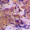 DOK1 Antibody - Immunohistochemical analysis of DOK1 staining in human breast cancer formalin fixed paraffin embedded tissue section. The section was pre-treated using heat mediated antigen retrieval with sodium citrate buffer (pH 6.0). The section was then incubated with the antibody at room temperature and detected with HRP and DAB as chromogen. The section was then counterstained with hematoxylin and mounted with DPX.