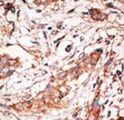 DOK4 Antibody - Formalin-fixed and paraffin-embedded human cancer tissue reacted with the primary antibody, which was peroxidase-conjugated to the secondary antibody, followed by DAB staining. This data demonstrates the use of this antibody for immunohistochemistry; clinical relevance has not been evaluated. BC = breast carcinoma; HC = hepatocarcinoma.