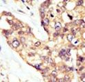 DOK5 Antibody - Formalin-fixed and paraffin-embedded human cancer tissue reacted with the primary antibody, which was peroxidase-conjugated to the secondary antibody, followed by AEC staining. This data demonstrates the use of this antibody for immunohistochemistry; clinical relevance has not been evaluated. BC = breast carcinoma; HC = hepatocarcinoma.