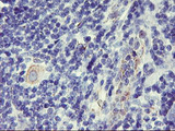 DPP9 Antibody - IHC of paraffin-embedded Human lymphoma tissue using anti-DPP9 mouse monoclonal antibody.