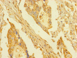 DPY30 Antibody - Immunohistochemistry of paraffin-embedded human pancreatic cancer using DPY30 Antibody at dilution of 1:100