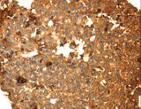 DRD5 / Dopamine Receptor D5 Antibody - Immunohistochemistry of paraffin-embedded Human breast cancer using DRD5 Polyclonal Antibody at dilution of 1:40.