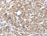 DSC1 / Desmocollin 1 Antibody - Immunohistochemistry of paraffin-embedded Human thyroid cancer using DSC1 Polyclonal Antibody at dilution of 1:40.