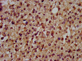 DSCAM Antibody - Immunohistochemistry image at a dilution of 1:200 and staining in paraffin-embedded human glioma cancer performed on a Leica BondTM system. After dewaxing and hydration, antigen retrieval was mediated by high pressure in a citrate buffer (pH 6.0) . Section was blocked with 10% normal goat serum 30min at RT. Then primary antibody (1% BSA) was incubated at 4 °C overnight. The primary is detected by a biotinylated secondary antibody and visualized using an HRP conjugated SP system.