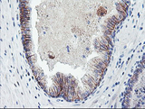 DTNB / Dystrobrevin Beta Antibody - IHC of paraffin-embedded Carcinoma of Human prostate tissue using anti-DTNB mouse monoclonal antibody.