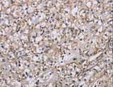 DTNB / Dystrobrevin Beta Antibody - Immunohistochemistry of paraffin-embedded Human prostate cancer using DTNB Polyclonal Antibody at dilution of 1:50.
