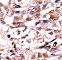 DUSP13 Antibody - Formalin-fixed and paraffin-embedded human cancer tissue reacted with the primary antibody, which was peroxidase-conjugated to the secondary antibody, followed by AEC staining. This data demonstrates the use of this antibody for immunohistochemistry; clinical relevance has not been evaluated. BC = breast carcinoma; HC = hepatocarcinoma.