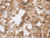 DUSP23 Antibody - Immunohistochemistry of paraffin-embedded Human thyroid cancer using DUSP23 Polyclonal Antibody at dilution of 1:30.