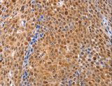 DUSP4 / MKP2 Antibody - Immunohistochemistry of paraffin-embedded Human ovarian cancer using DUSP4 Polyclonal Antibody at dilution of 1:30.
