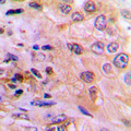 DUSP6 / MKP3 Antibody - Immunohistochemical analysis of DUSP6 staining in human lung cancer formalin fixed paraffin embedded tissue section. The section was pre-treated using heat mediated antigen retrieval with sodium citrate buffer (pH 6.0). The section was then incubated with the antibody at room temperature and detected using an HRP-conjugated compact polymer system. DAB was used as the chromogen. The section was then counterstained with hematoxylin and mounted with DPX.