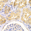DUSP6 / MKP3 Antibody - Immunohistochemistry of paraffin-embedded human kidney cancer tissue.