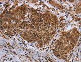 DUSP8 Antibody - Immunohistochemistry of paraffin-embedded Human cervical cancer using DUSP8 Polyclonal Antibody at dilution of 1:30.