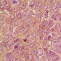 DUSP9 Antibody - Immunohistochemical analysis of DUSP9 staining in human breast cancer formalin fixed paraffin embedded tissue section. The section was pre-treated using heat mediated antigen retrieval with sodium citrate buffer (pH 6.0). The section was then incubated with the antibody at room temperature and detected using an HRP polymer system. DAB was used as the chromogen. The section was then counterstained with hematoxylin and mounted with DPX.