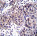 DVL3 / Dishevelled 3 Antibody - DVL3 Antibody immunohistochemistry of formalin-fixed and paraffin-embedded human breast carcinoma followed by peroxidase-conjugated secondary antibody and DAB staining.
