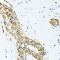 Dynactin 2 / Dynamitin Antibody - Immunohistochemistry of paraffin-embedded human breast cancer tissue.