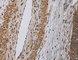 Dynactin 3 / DCTN3 Antibody - Immunohistochemistry of paraffin-embedded Human cervical cancer using DCTN3 Polyclonal Antibody at dilution of 1:50.