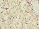 DYNC1I1 Antibody - Immunohistochemistry of paraffin-embedded human gastric cancer at dilution of 1:100