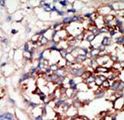 DYRK1B Antibody - Formalin-fixed and paraffin-embedded human cancer tissue reacted with the primary antibody, which was peroxidase-conjugated to the secondary antibody, followed by DAB staining. This data demonstrates the use of this antibody for immunohistochemistry; clinical relevance has not been evaluated. BC = breast carcinoma; HC = hepatocarcinoma.