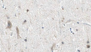 DZIP3 Antibody - 1:100 staining human brain carcinoma tissue by IHC-P. The sample was formaldehyde fixed and a heat mediated antigen retrieval step in citrate buffer was performed. The sample was then blocked and incubated with the antibody for 1.5 hours at 22°C. An HRP conjugated goat anti-rabbit antibody was used as the secondary.