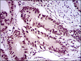 E2F1 Antibody - IHC of paraffin-embedded rectum cancer tissues using E2F1 mouse monoclonal antibody with DAB staining.