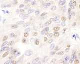 E2F4 Antibody - Detection of Human E2F4 by Immunohistochemistry. Sample: FFPE section of human breast carcinoma. Antibody: Affinity purified rabbit anti-E2F4 used at a dilution of 1:1000 (1 Detection: DAB.