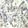 E2F6 Antibody - Immunohistochemistry of paraffin-embedded human gastric cancer tissue.