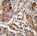 EBP Antibody - Formalin-fixed and paraffin-embedded human hepatocarcinoma reacted with EBP Antibody , which was peroxidase-conjugated to the secondary antibody, followed by DAB staining. This data demonstrates the use of this antibody for immunohistochemistry; clinical relevance has not been evaluated.