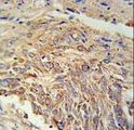 EBPL Antibody - EBPL Antibody immunohistochemistry of formalin-fixed and paraffin-embedded human lung carcinoma followed by peroxidase-conjugated secondary antibody and DAB staining.